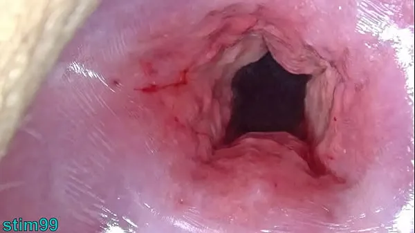 Big Uncensored Japanese Cervix Stretching and Uterus Dilation with Penetration best Clips